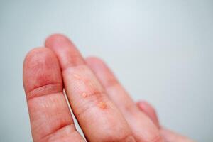 verruga en el dedo de el mano. papiloma en el brazo. piel enfermedad. erupción de crecimientos en el Superior cubrir de el piel. foto