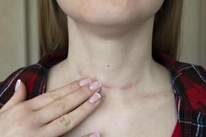 scar after surgery on woman neck photo