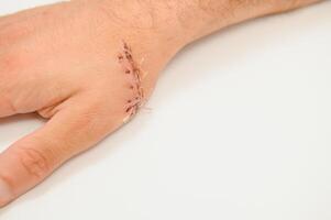 Close-up of a hand wound with stitches photo