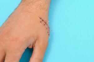 Close-up of a hand wound with stitches photo