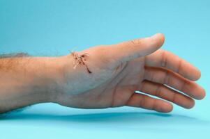 Close-up of a hand wound with stitches photo