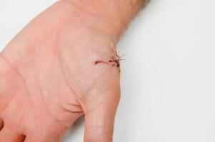 Close-up of a hand wound with stitches photo