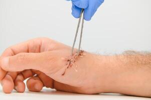 Suture wound on hand from dermatology procedure photo