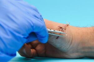 médico examinando nervio conducción en palma de mano después de mano túnel síndrome foto
