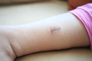 Stitched wound mark on a child foot. photo