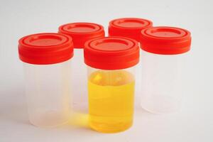 Urinalysis, urine cup for check health examination in laboratory. photo