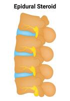 epidural esteroide Ciencias diseño vector ilustración diagrama