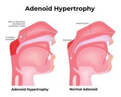 Adenoid Hypertrophy Science Design Vector Illustration Diagram