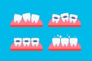 Teeth, orthodontic treatment. Braces on the teeth. Dental care health. Vector illustration