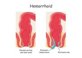 hemorroides en el recto. vector ilustración en dibujos animados estilo.