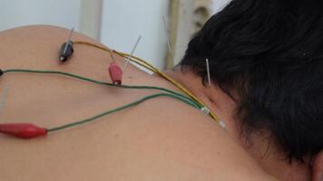 Closeup needles on patient back stimulated by electric. Acupuncture, Chinese alternative medicine. video