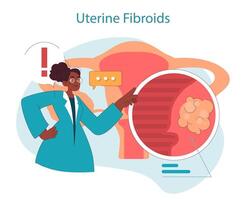 Uterine fibroids. Doctor illustrates uterine fibroids condition, zooming vector