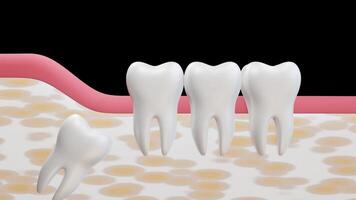 Tooth impaction 3d animation video