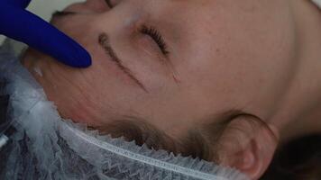 Close-up shot of doctor-cosmetologist make botulinum toxin forehead injection. video