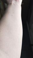 templado alérgico erupción en interior lado de el brazo de caucásico masculino video