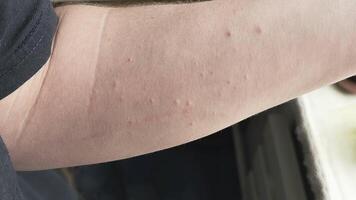 scratching itchy mild allergic rash on inner side of the arm of Caucasian male video