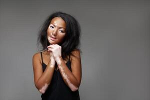 Beautiful African girl in studio with skin problems Vitiligo studio shooting photo