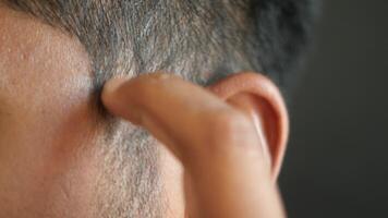 man with dandruff in his hair, closeup video