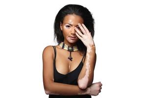 Beautiful African girl in studio with skin problems Vitiligo studio shooting photo