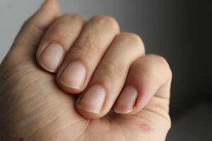 de cerca de un mujer mano. dañado dedos en el mano foto