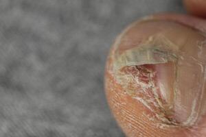 Fungal diseases of the nails and skin of the feet close-up. Podology and treatment options for nail plates. photo