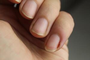 Close-up of the fingers of the left hand with the injured little finger. Inflammation of the nail plate. Manicure Recovery Nail Plate Treatment photo