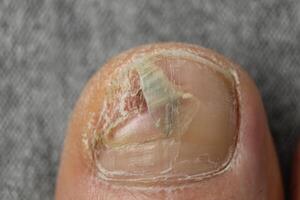 nail diseases. Destroyed nail plate, fungal diseases of the feet. Podology photo