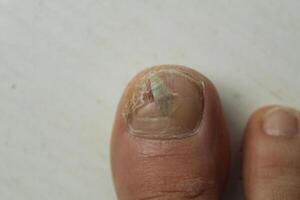 Fungal diseases of the nails and skin of the feet close-up. Podology and treatment options for nail plates. photo