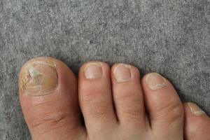 dañado uña del dedo del pie plato de cerca. uña y piel enfermedades hongo foto
