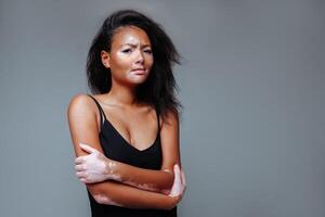 beautiful african girl with a skin problem hugging herself in a studio with both hands photo