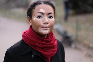 A beautiful young girl of African ethnicity with vitiligo standing on the warm spring city street dressed black coat photo