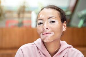 Black african american woman with vitiligo pigmentation skin problem indoor dressed pink hoodie photo