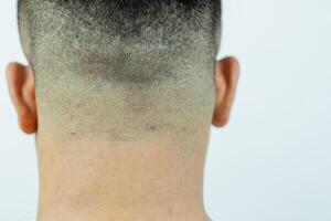 de cerca ver de tiña en el cabeza de un asiático hombre, dermatitis. rojo lugares aparecer, que produce picor y escamoso caspa en el cabeza. foto