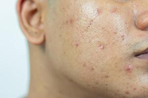 piel problemas. problema de enconado acné en el rostro. enconado acné consiste de hinchazón, enrojecimiento, y poros ese son severamente obstruido con bacterias, aceite, y muerto piel células. foto