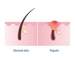 Papule, type of inflammatory acne vector isolated on white background. Cross section of normal skin and papule pimple is small, solid, red, inflamed bump in skin layer. Skin care concept illustration.