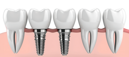 ai généré détaillé 3d illustration de une dentaire implant dans oral se soucier sur transparent Contexte - Stock png. png