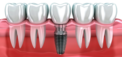 ai generado detallado 3d ilustración de un dental implante en oral cuidado en transparente antecedentes - valores png. png