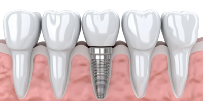 AI generated Detailed 3D illustration of a dental implant in oral care on transparent background - stock png. png