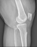 X-ray of the bones of knee of a man. Medical concept. photo