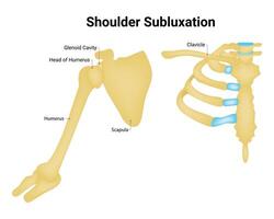 Shoulder Subluxation Science Design Vector Illustration Diagram