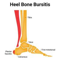 Heel Bone Bursitis Science Design Vector Illustration Diagram