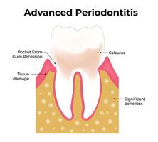 avanzado periodontitis Ciencias diseño vector ilustración diagrama