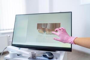 mano en rosado guantes muestra radiografía de dientes en monitor. foto