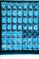 X-ray image of the brain computed tomography. Neurosurgery concept. photo