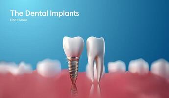 blanco diente implante implante cortar, sano diente o dental cirugía. vector