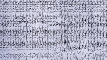 imagen de ictal eeg grabación en epilepsia paciente foto