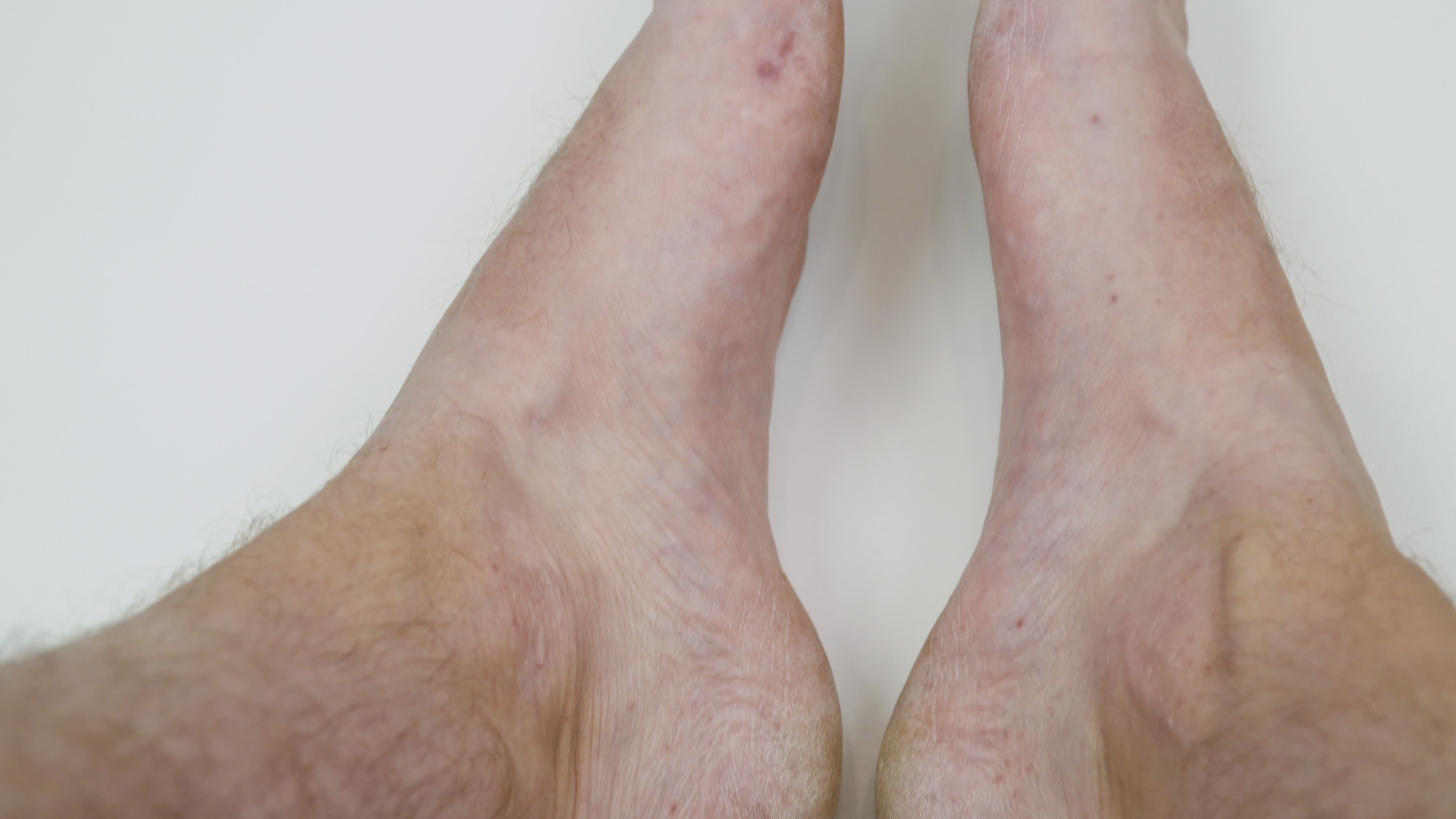 Painful rash, red blisters on a man's leg. Human legs with dermatitis