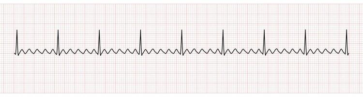 ekg monitor demostración auricular aleteo vector