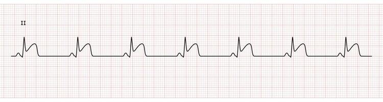 EKG Monitor in lead II Showing  Sinus Rhythm with STEMI at Inferior Wall vector