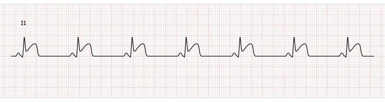 EKG Monitor in lead II Showing  Sinus Rhythm with STEMI at Inferior Wall vector